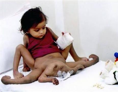 Indian Girl Born With Eight Limbs
