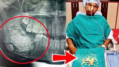 232 Teeth Removed From 17-Year Old Indian Boy’s Mouth